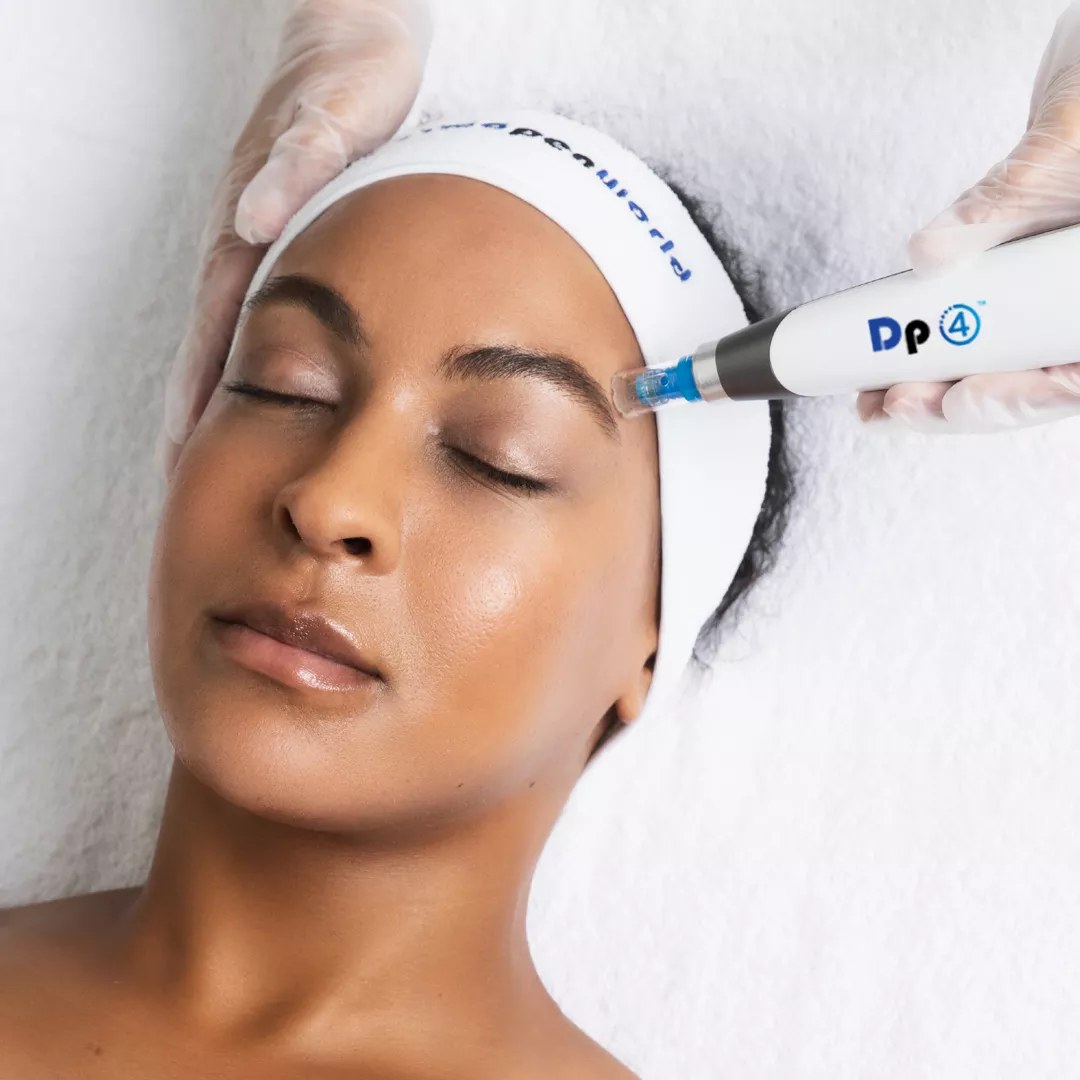 Microneedling
